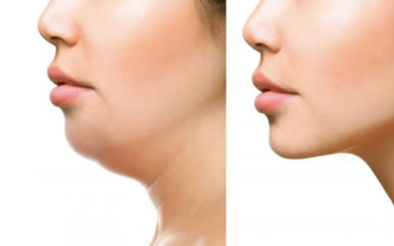 Mentoplastia ou Lipo de Papada