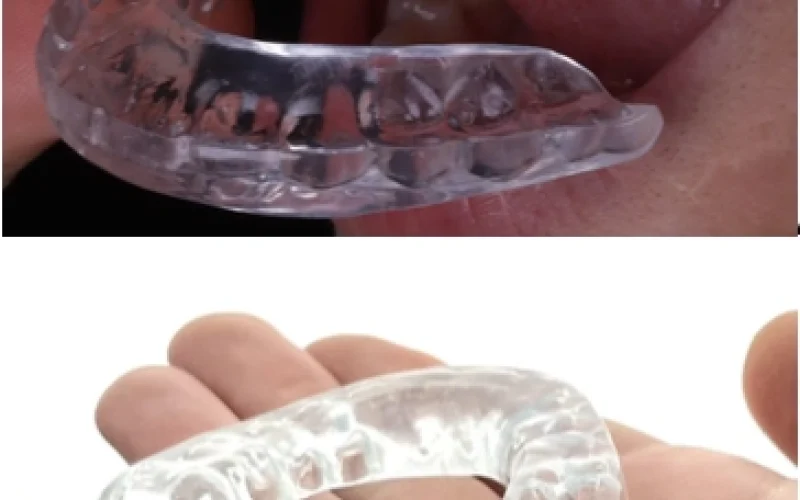 Placa oclusal para tratamento de disfunção de ATM - 1